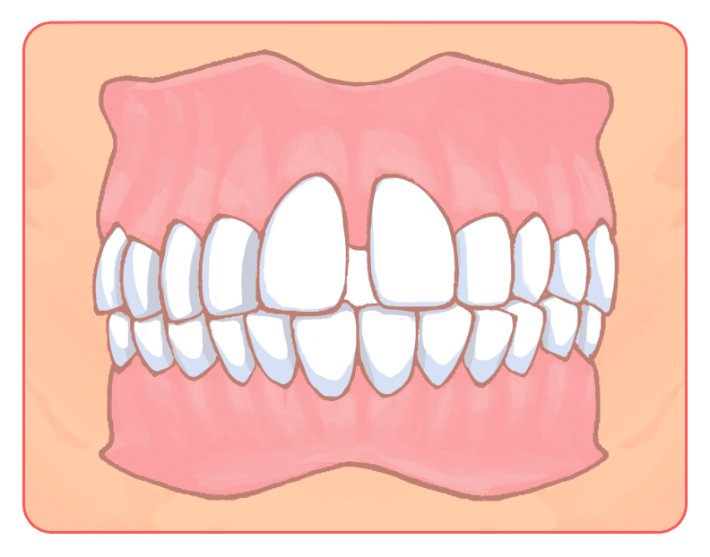空隙歯列（くうげきしれつ）