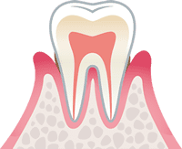軽度歯周炎