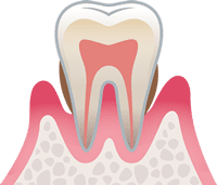 中等度歯周炎