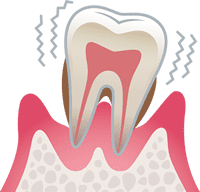 重度歯周炎